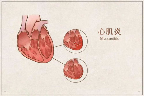 病毒感染警惕心肌炎
