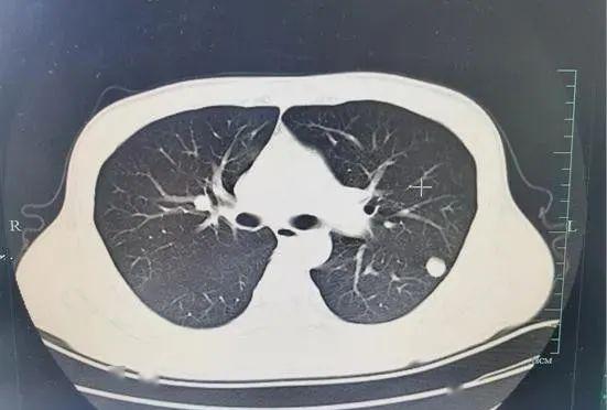 腹泻两周 小伙查出感染“鬼脸虫”