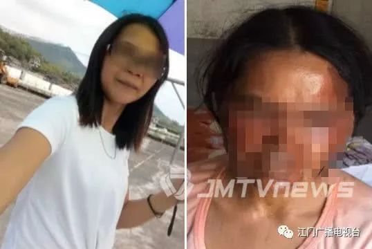 95%烧伤女孩订婚